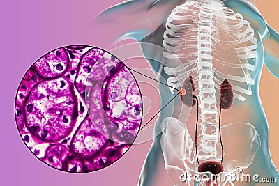 Kidney cancer, illustration and light micrograph Cartoon Illustration