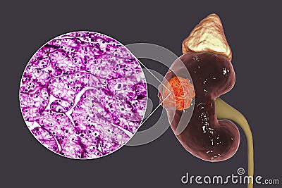 Kidney cancer, illustration and light micrograph Cartoon Illustration