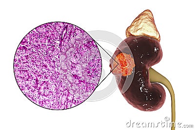 Kidney cancer, illustration and light micrograph Cartoon Illustration