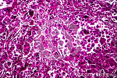 Kidney cancer, light micrograph Stock Photo