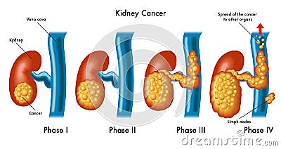 Kidney cancer Vector Illustration