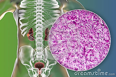Kidney cancer, illustration and light micrograph Cartoon Illustration