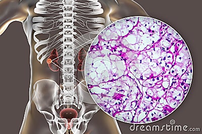 Kidney cancer, illustration and light micrograph Cartoon Illustration