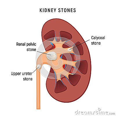 Kidney cartoon stones disease vector infographic. Urinary renal kidnay stone surgey background anatomy failure Vector Illustration