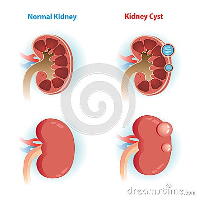 Kidney Cyst Vector Illustration