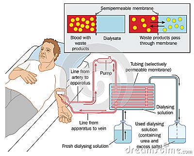 Kidney dialysis Vector Illustration