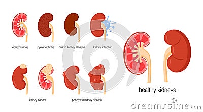 Kidney diseases concept in flat style, vector Vector Illustration