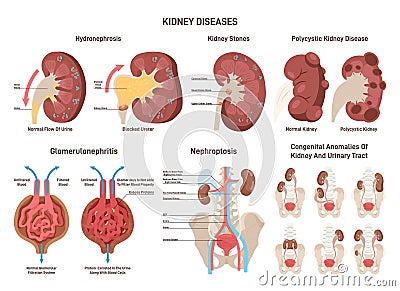 Kidney diseases set. Renal failure, urinary system organ medical Vector Illustration