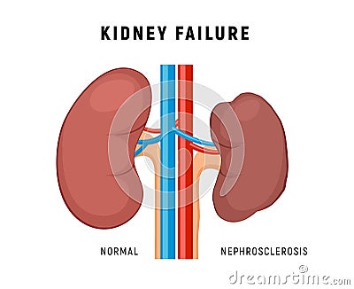 Kidney failure chronic disease urinary renal cancer. Kidney failure nephritis nephrosclerosis. Vector Illustration