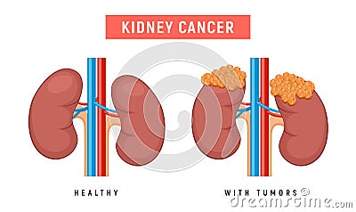 Kidney polycystic disease kidney cancer urology pyelonephritis failure tumor illustration Vector Illustration