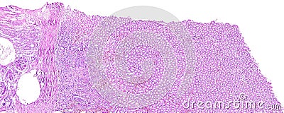 Kidney proximal tubule epithelial cloudy swelling of a human Stock Photo