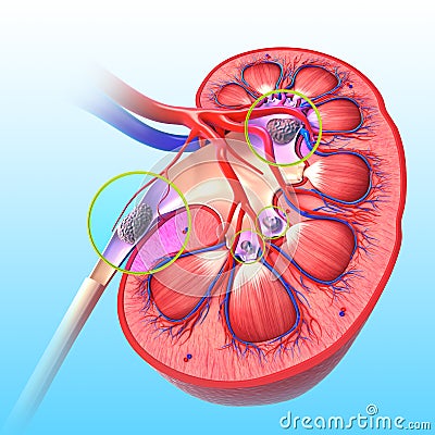 Kidney stone Cartoon Illustration