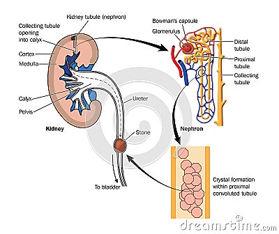 Kidney stone formation Stock Photo