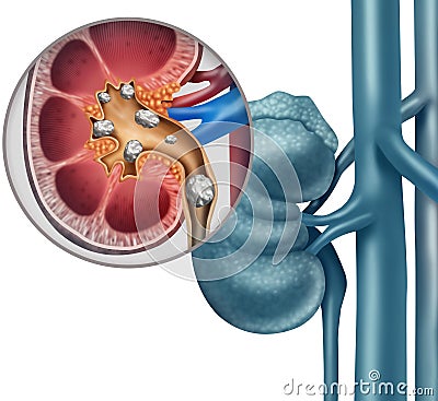 Kidney Stone Diagram Cartoon Illustration
