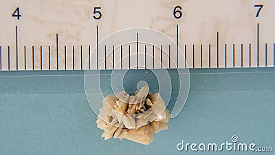 KIDNEY STONE 9mm Stock Photo