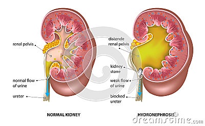 Kidney stone Vector Illustration