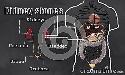 Kidney Stones illustration Stock Photo