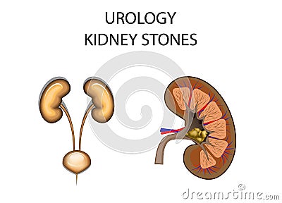Kidney stones Vector Illustration