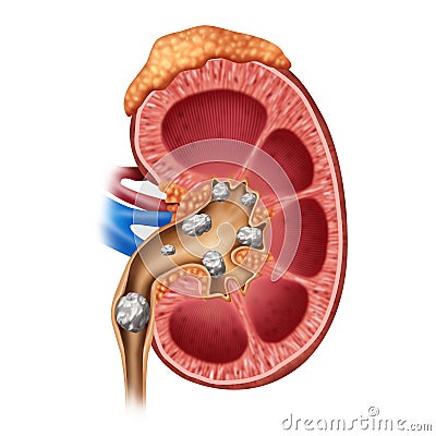 Kidney Stones Cartoon Illustration