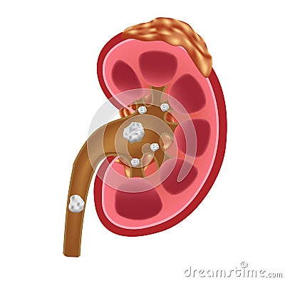 Kidney stones medical concept vector . anatomy Vector Illustration