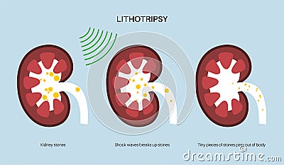 Lithotripsy procedure concept Vector Illustration