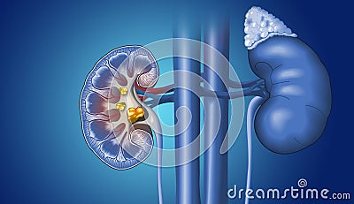 Kidney stones in kidney and ureter, medically illustration Stock Photo