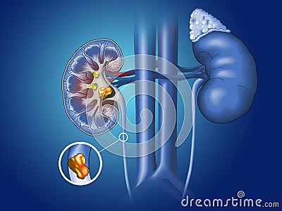 Kidney stones in kidney and ureter, medically illustration Stock Photo