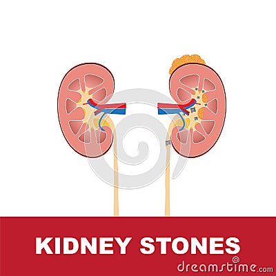 Kidney stones vector illustration Vector Illustration