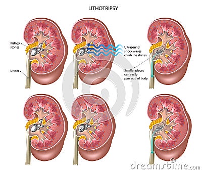 Kidney stones Vector Illustration