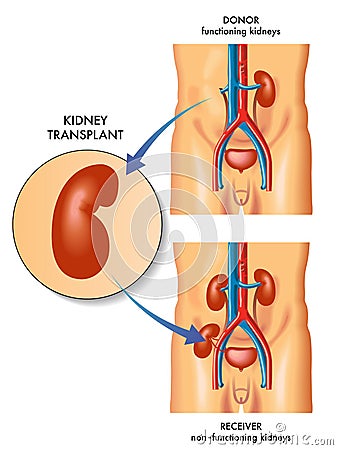 Kidney Transplant Vector Illustration