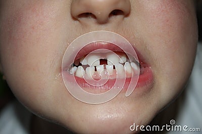 Kids teeths - closeup look Stock Photo