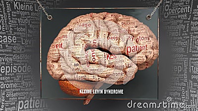 Kleine levin syndrome in human brain Stock Photo