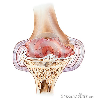 Knee - Advanced Osteoarthritis Stock Photo