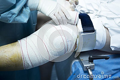 Knee arthroscopy orthopedic surgery operation Stock Photo