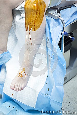 Knee arthroscopy orthopedic surgery operation Stock Photo