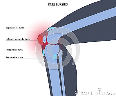 Bursitis inflammation concept Vector Illustration