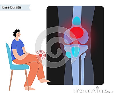 Bursitis inflammation concept Vector Illustration