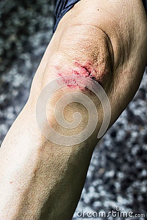 Knee after a fall Stock Photo