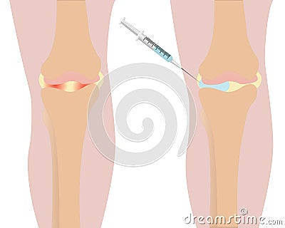 Knee injection inflamation redness Vector Illustration