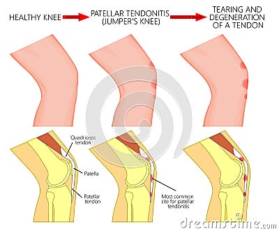 Knee joint problem_Patellar tendonitis or jumper knee. Progress Vector Illustration