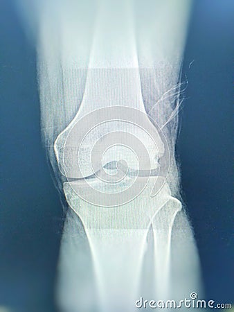 Knee joint x-ray views Fracture tibial eminence is suspected. Left knee joint fluid is seen Stock Photo