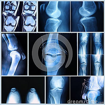 Knee medical exam: X-ray and MRI scan Stock Photo