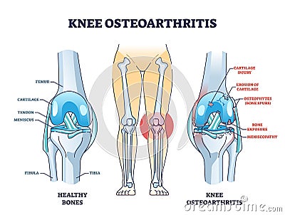 Knee osteoarthritis condition with skeletal bone degeneration outline diagram Vector Illustration
