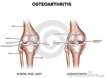 Knee Osteoarthritis Vector Illustration