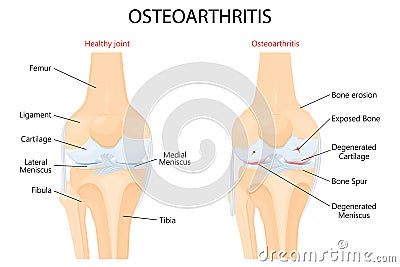 Knee Osteoarthritis and normal joint detailed anatomy. Osteoarthritis. Arthritis or pain within a joint. degenerative joint Vector Illustration