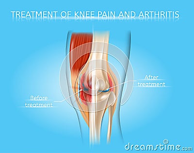 Knee Pain and Arthritis Treatment Vector Chart Vector Illustration