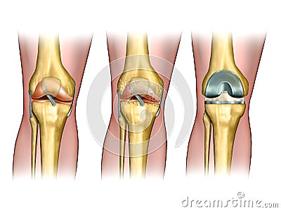 Knee replacement Cartoon Illustration