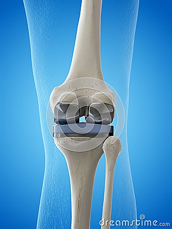 a knee replacement Cartoon Illustration