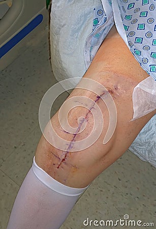 Knee replacement surgery scar Stock Photo