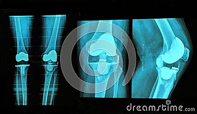 knee replacement xray Stock Photo